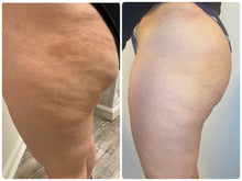 Load image into Gallery viewer, Cellulite Reduction &amp; Skin Tightening
